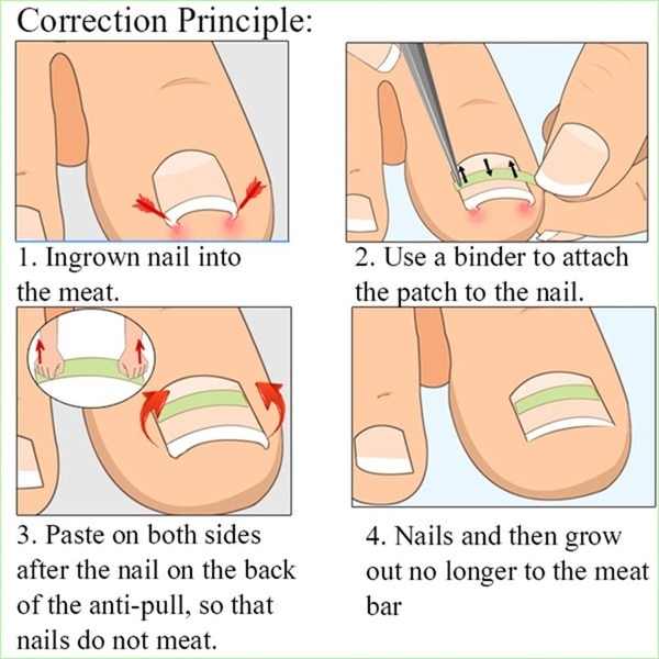 Stainless Steel Ingrown Toe Nail Correction Tool +10Pcs Nail Correction Patch Nails Art Equipment Tool