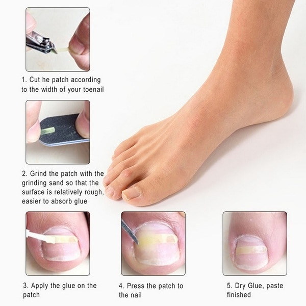 Stainless Steel Ingrown Toe Nail Correction Tool +10Pcs Nail Correction Patch Nails Art Equipment Tool