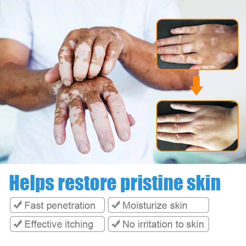 20g Herbal Extract Vitiligo Ointment Remove Ringworm White Spot Removal Skin White Spot Leukoplakia Disease Treatment Cream