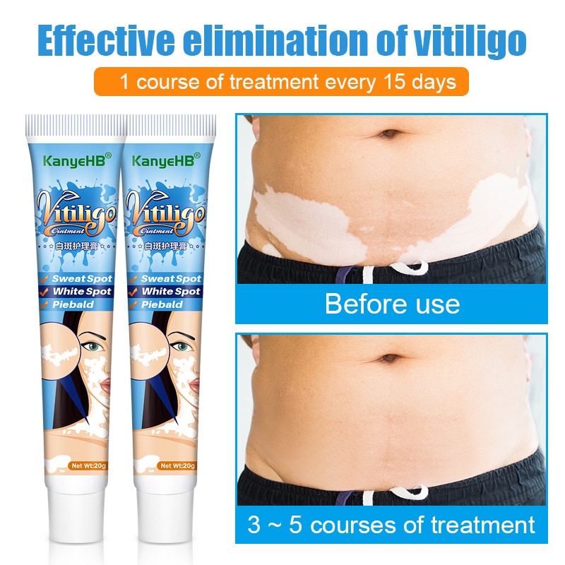 20g Herbal Extract Vitiligo Ointment Remove Ringworm White Spot Removal Skin White Spot Leukoplakia Disease Treatment Cream